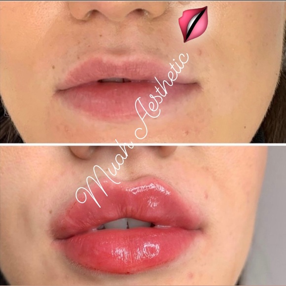 Hyaluronic acid - Picture 2 of 2